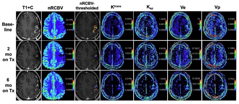 CPatel_Lab's tweet image. We report (doi.org/10.1177/197140…) initial #clinical data regarding #TTFields increasing #Glioblastoma  blood volume and blood-brain barrier #permeability, which needs to be prospectively validated. #collab w/ @Michael_Iv_MD, @Stanford_Neuro et al. Thank you @AACR &amp;amp; @McNairFdn