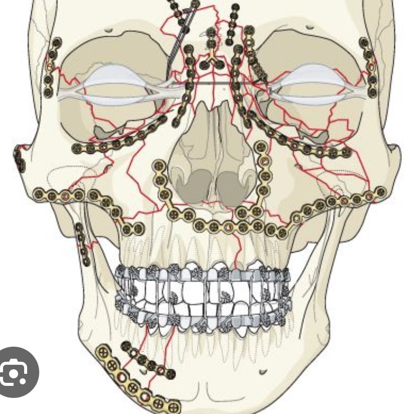 rb.gy/7px6dc
Calling future #Maxillofacial #FutureSurgeons Fab scope  of work. 
open day for medics planing to study dentistry kingsdentistry <a href="/KingsCollegeLon/">King's College London</a> <a href="/jtg_baoms/">Junior Trainee Group - BAOMS</a> ⁦<a href="/BAOMSOfficial/">BAOMS</a>⁩ ⁦<a href="/FitOmfs/">OMFS FiT</a>⁩ ⁦<a href="/ASiTofficial/">ASiT</a>⁩ ⁦<a href="/UKSWiMS/">SWiMS</a>⁩