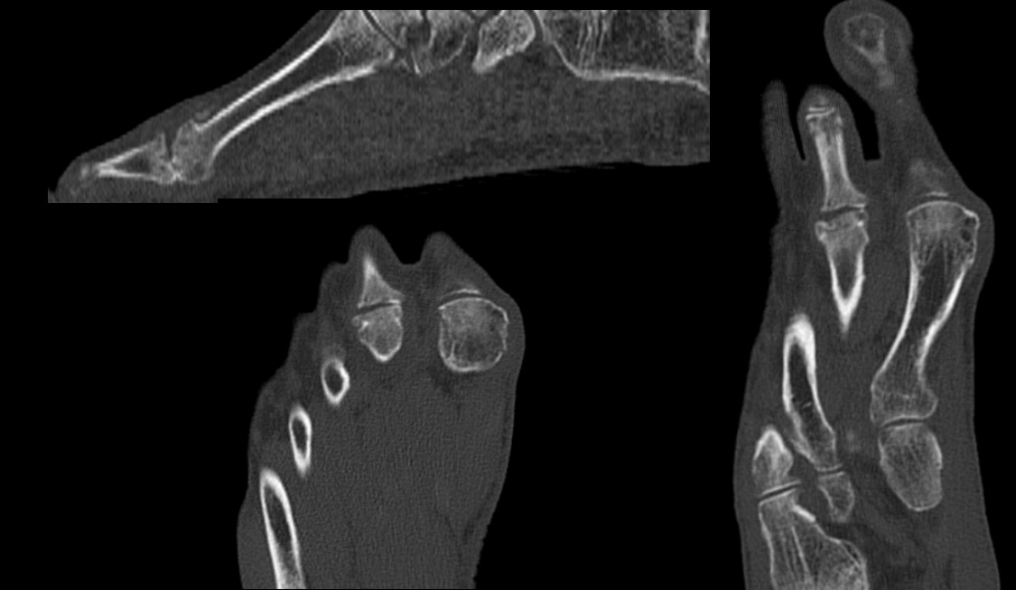 CIC0826's tweet photo. 70-year-old, female with chronic metatarsalgia.
Various images of osteochondrosis in the head of the second metatarsal.
Note the deformity, cortical irregularity of the head of the second metatarsal, with subchondral bone edema on MRI.
#feet #MRI  #MSK  #radiology https://t.co/wO0whjuqga