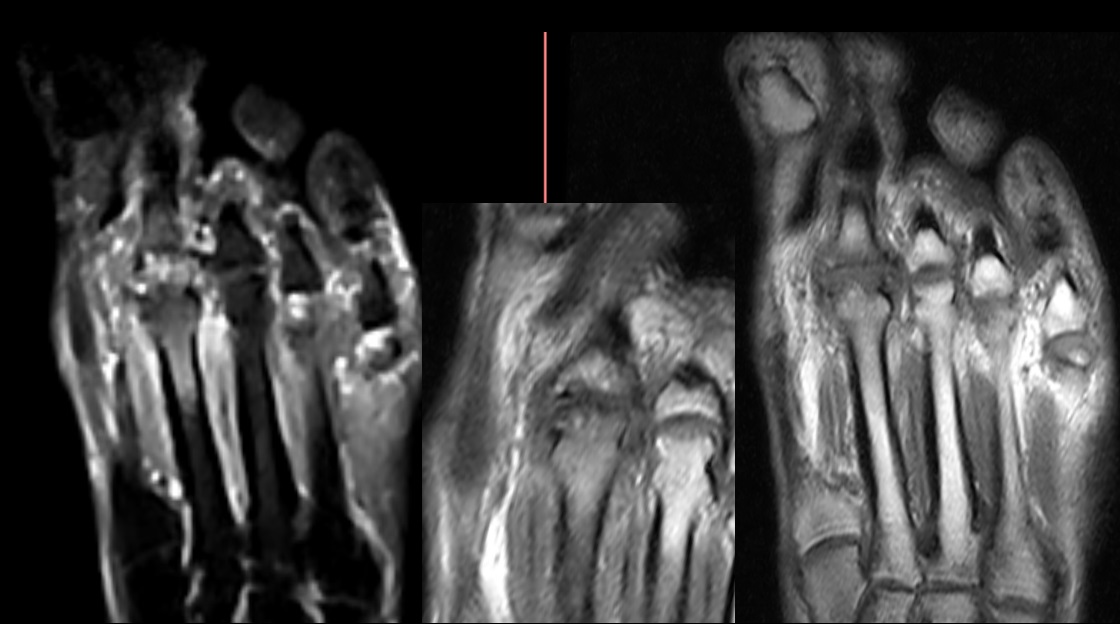 CIC0826's tweet photo. 70-year-old, female with chronic metatarsalgia.
Various images of osteochondrosis in the head of the second metatarsal.
Note the deformity, cortical irregularity of the head of the second metatarsal, with subchondral bone edema on MRI.
#feet #MRI  #MSK  #radiology https://t.co/wO0whjuqga