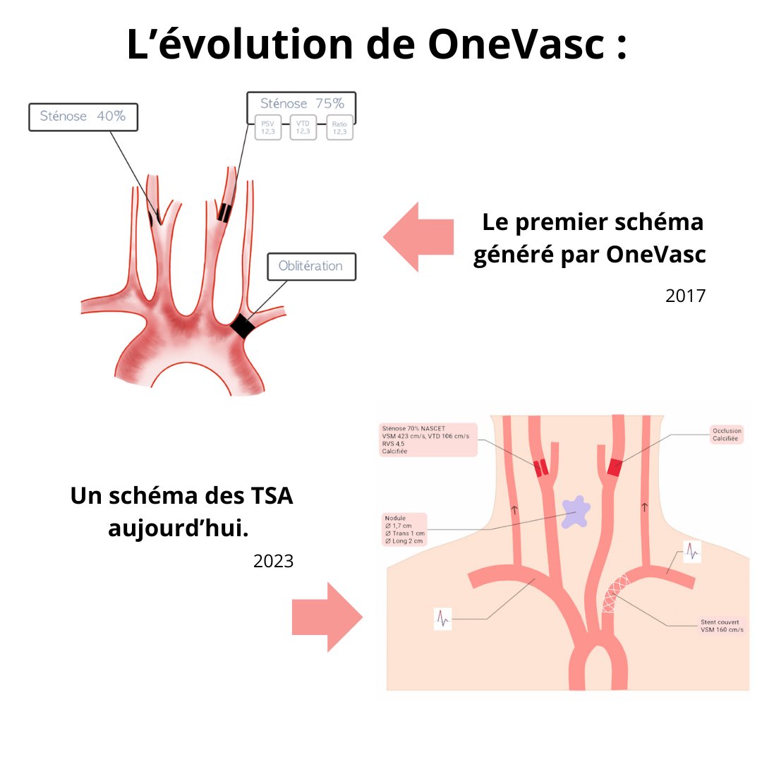 onevasc's tweet photo. Souvenirs, souvenirs... nous avons retrouvé le premier schéma généré par OneVasc pour vous donner une idée de notre évolution depuis ! 

#medecinevasculaire #schemavasculaire #angiologie #chirurgievasculaire #radiologie #innovationensante https://t.co/aKkX7LkqWL