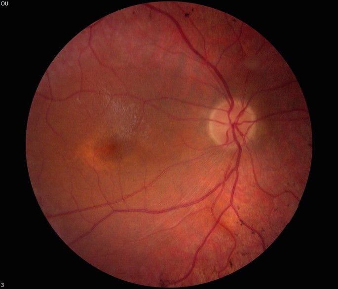 MarcusHouse's tweet photo. So, a tough personal thread to write here. 🥺 I haven't really gone into this publicly before, but I feel I need help. My eldest son Alex (14yo), has a rare eye condition in the CRB1 Retinal Dystrophy family. 😢
Essentially mostly blind in one eye, and almost legally blind in the other. Each day is a challenge, but it has never stopped his love of learning. He manages to keep up at a regular school even with the hardship. Although my wonderful wife and I have dealt well with this psychologically so far, the past few months I've been personally struggling. Due to its rarity, it is hard to find other parents in a similar situation, and I just feel like I'm maybe failing him in some of the areas he needs help.
Is there anyone out there that has a child with a similar CRB1 condition? Perhaps one that has a lot of expertise with this? I sure would love to get another perspective on how to help him cope with the new challenges that teens face. Even moreso when you can't see anyone's face, expressions etc.