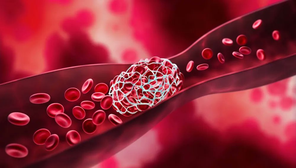 A🧵 on FIBRINOLYTICS

First  a fact check 👇

INTRAVENOUS THROMBOLYSIS can be successfull if given

A. Within 30minutes to 12 hrs in STEMI

B. Within 3-4.5 hrs in  Acute ischemic stroke

C. Within 14 days in Pulmonary embolism

Choose ✅️TRUE statement/s among  above #Medtwitter