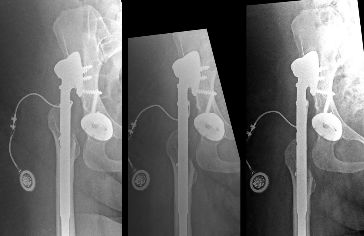 stewy6's tweet photo. "Reduction of High Hip Dislocation With a Distraction Nail and Arthroplasty" ... A novel technique providing a biologically logical solution for high hip dysplasia https://t.co/ZSD4VlAA0Y https://t.co/AwkE6mlTs7