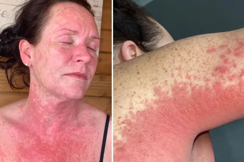mRNAdeaths's tweet photo. Mum left in agony with a burning rash due to ‘severe reaction to Covid vaccine two weeks after jab’
Leigh King 41 suffered a skin rash that burns after first dose of the #AstraZeneca vaccine.
https://t.co/DJxwO2TFhU https://t.co/8TU6iz85x1