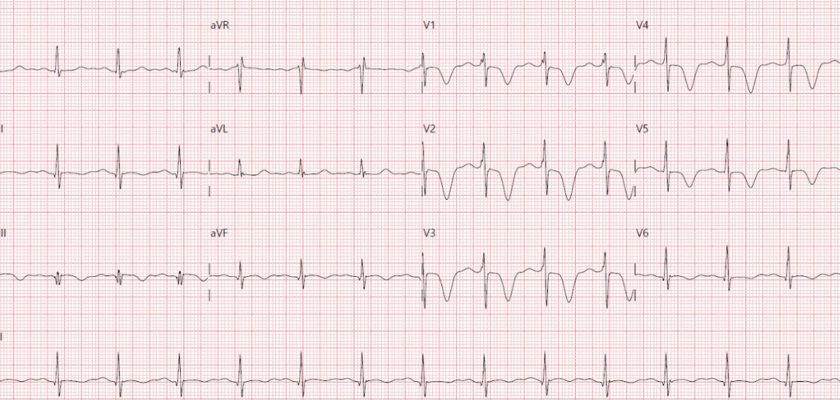 Surprising finding on the MRI. The heart is not everything.

First let’s look at the ECG…

Follow the thread 🪡 

#WhyCMR <a href="/Angi_RomeroMD/">Angelica Maria Romero Daza</a> <a href="/UICARdiologia/">Unidad Integral de Cardiología - UICAR</a> <a href="/Hospital_LaLuz/">Hospital La Luz</a> #scary_movie_cardio