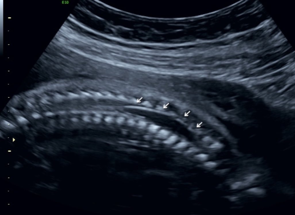 Second trimester ultrasound of a fetus with open spina bifida (lumbar myelomeningocele not shown).

The arrows point to a region of the cervical and upper thoracic spinal cord. 

What is this translucent structure, and what are the implications of this finding?

#SpinaBifida