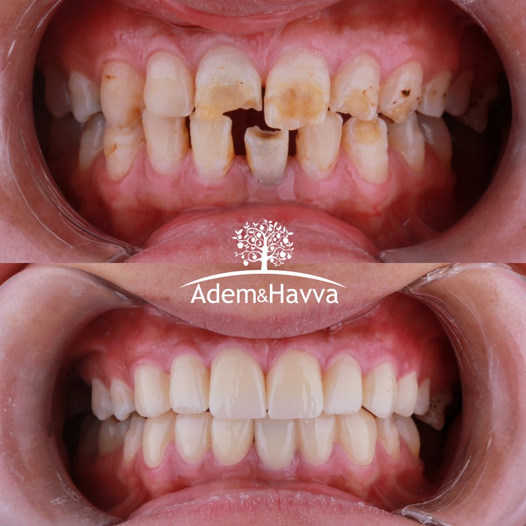 AdemHavvaHealth's tweet photo. 🦷✨Smile, it raises your face value!✨🦷
Dental treatment with a professional care in Istanbul

📞 +90 549 629 14 53
https://t.co/ueDQ62yhT5

✅Free Consultation
✅Free X-ray panoramic
✅Get free quote

#TeethWhitening #Teeth #Veneers #PerfectSmile #HolywoodSmile #SmileMakeover https://t.co/C2Ti1fuN20