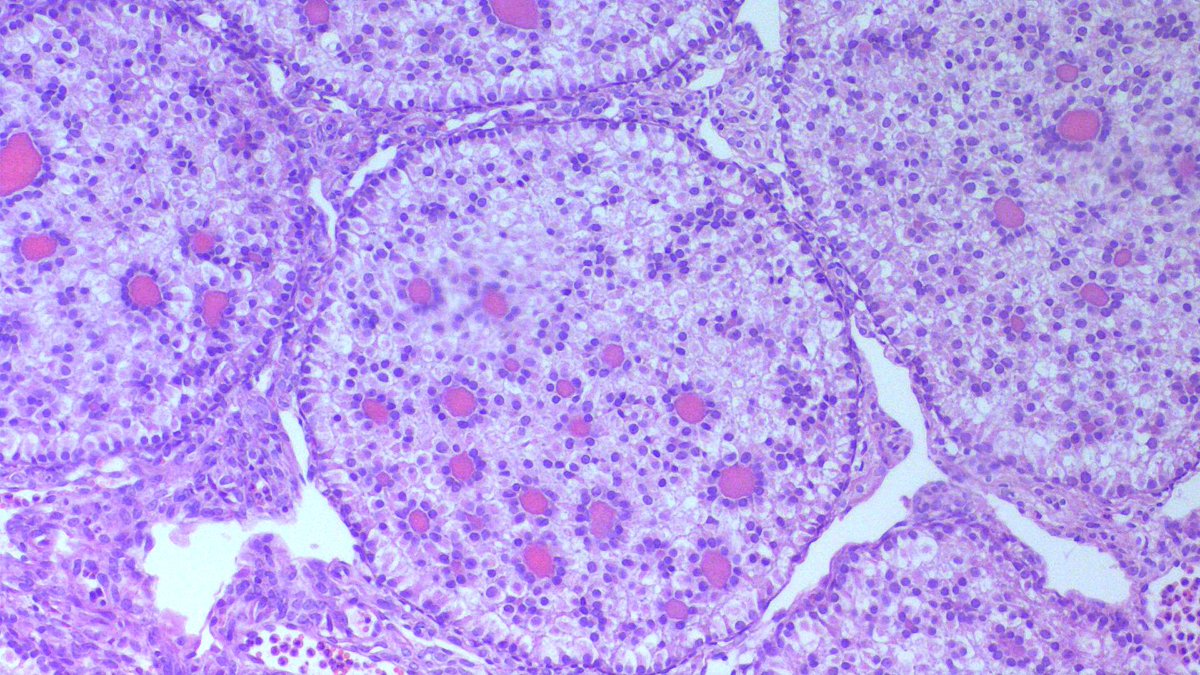A 13 yr old girl 👧with irregular and prolonged menses. Right ovarian mass, 8x6cm. Capsulated & gray white- orange solid cut surface. 
~Inhibin⬆️
#GUTpath
🔬A classic case!
