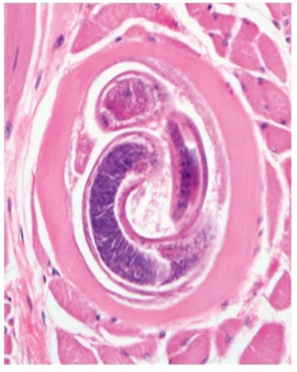 A patient in Korea presented with fever, headache, myalgias & diarrhea one week after eating raw, soft-shelled turtle meat. Labs w/eosinophilia. Bachman test was positive. What is the likely diagnosis? #MedEd