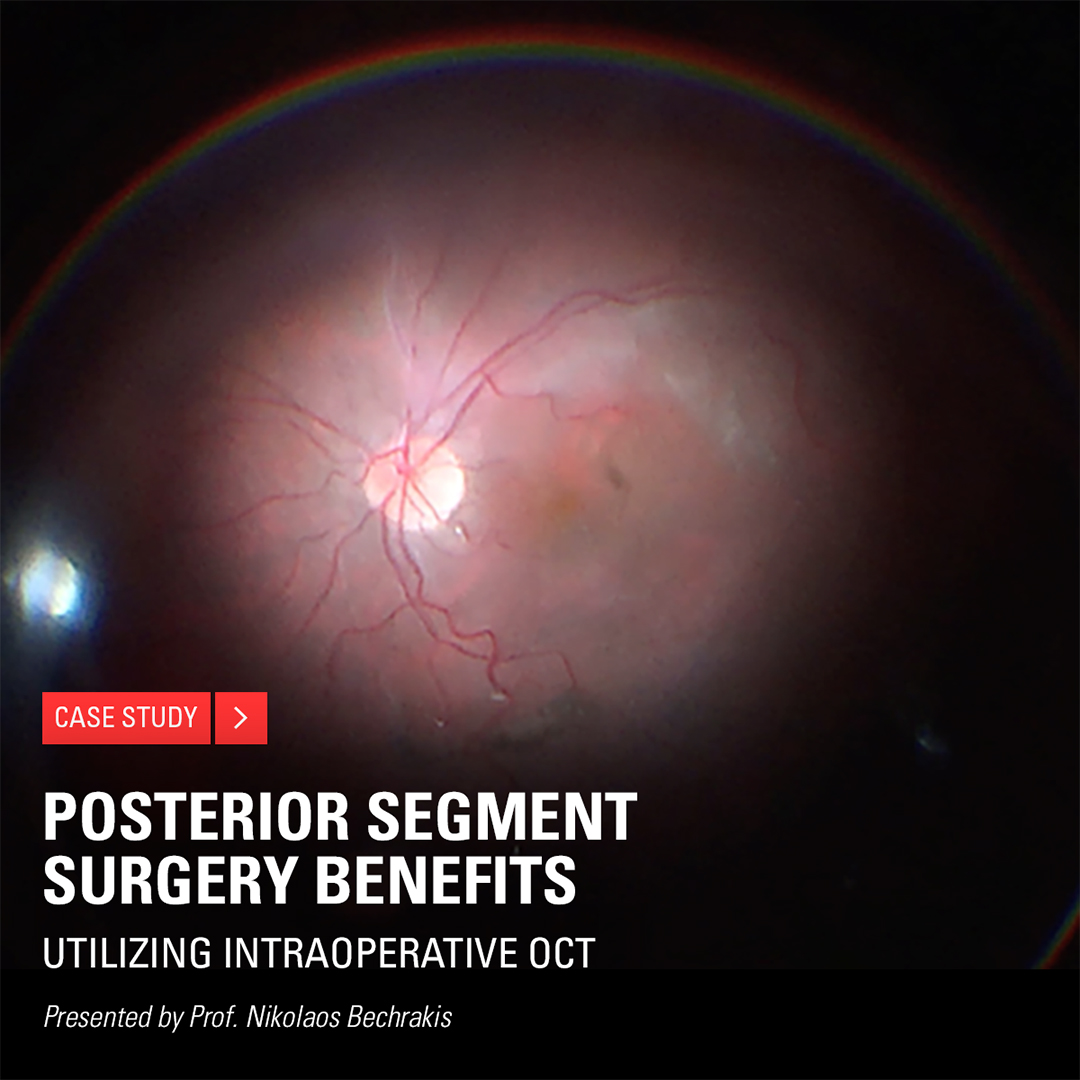 LeicaMicro's tweet photo. Do you perform posterior segment surgery? Discover how intraoperative optical coherence tomography supports the precise localization, evaluation, and management of #posteriorsegment pathologies, providing advanced visualization and insights. @bechrakis
👉https://t.co/leooSNrSW3 https://t.co/UKhwweryA7
