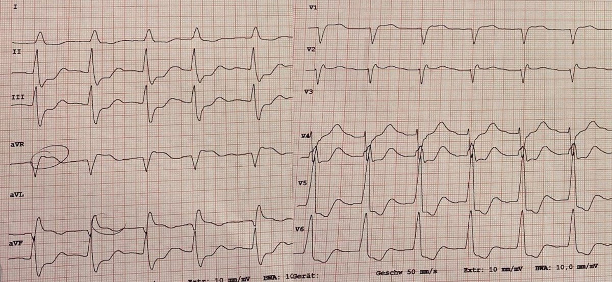 You are on call. At 4 am (really a tough time), they call you for a 75 yr-old male with known CAD/8 stents just admitted with chest pain and this ECG. What do you do? @bordistef @doc_ecmo @GhanemAlexander @AGIKinterv @HolgerNef @Kardiophil @Hannah_Billig_