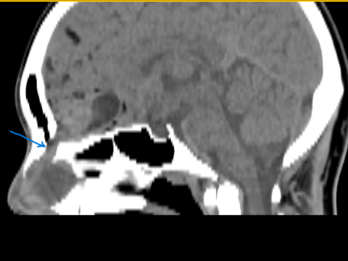 Ganymade__'s tweet photo. ✍️Ruptured intracranial dermoid cysts
✍️Nasal Dermoid Sinus Cysts
✍️ Fat droplets in the subarachnoid space or ventricles scans is diagnostic for a ruptured dermoid cyst
#brain #CT #dermoidcyst #Neurosurgery #residency #medicine #radiology #educartion https://t.co/t7E6kliJ9G