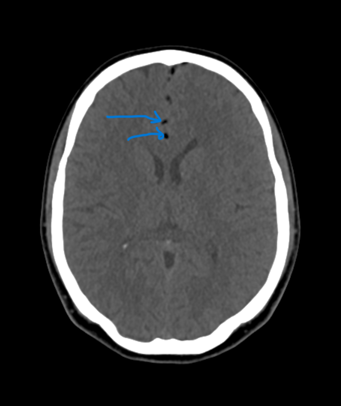 Ganymade__'s tweet photo. ✍️Ruptured intracranial dermoid cysts
✍️Nasal Dermoid Sinus Cysts
✍️ Fat droplets in the subarachnoid space or ventricles scans is diagnostic for a ruptured dermoid cyst
#brain #CT #dermoidcyst #Neurosurgery #residency #medicine #radiology #educartion https://t.co/t7E6kliJ9G