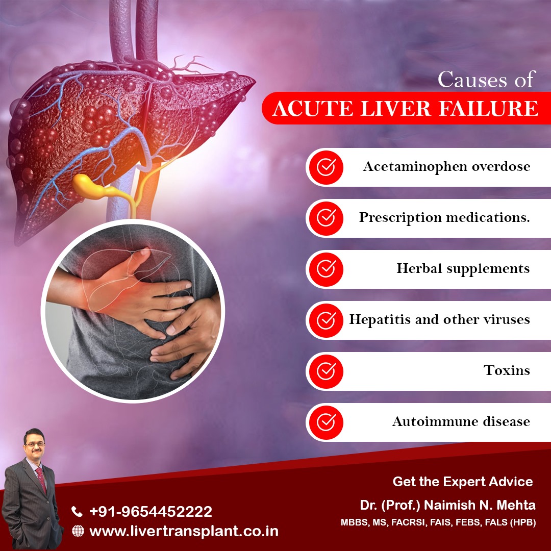 mehta_naimish's tweet image. Causes of Acute Liver Failure
- Acetaminophen overdose
- Prescription medications
- Herbal supplements
- Hepatitis and other viruses
- Toxins
- Autoimmune disease

#acuteliverfailure #liverproblem #liverspecialist #liverdoctor #drnaimishmehta