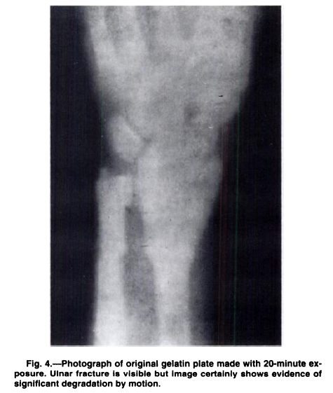 Happy International Day of Medical Physics! Celebrating medical physicists all over the world w/ a special shoutout to our students and faculty #WeWhoCurie #IDMP23 Did you know the first clinical xray in America was taken at Dartmouth? A broken wrist while ice skating no less🥶