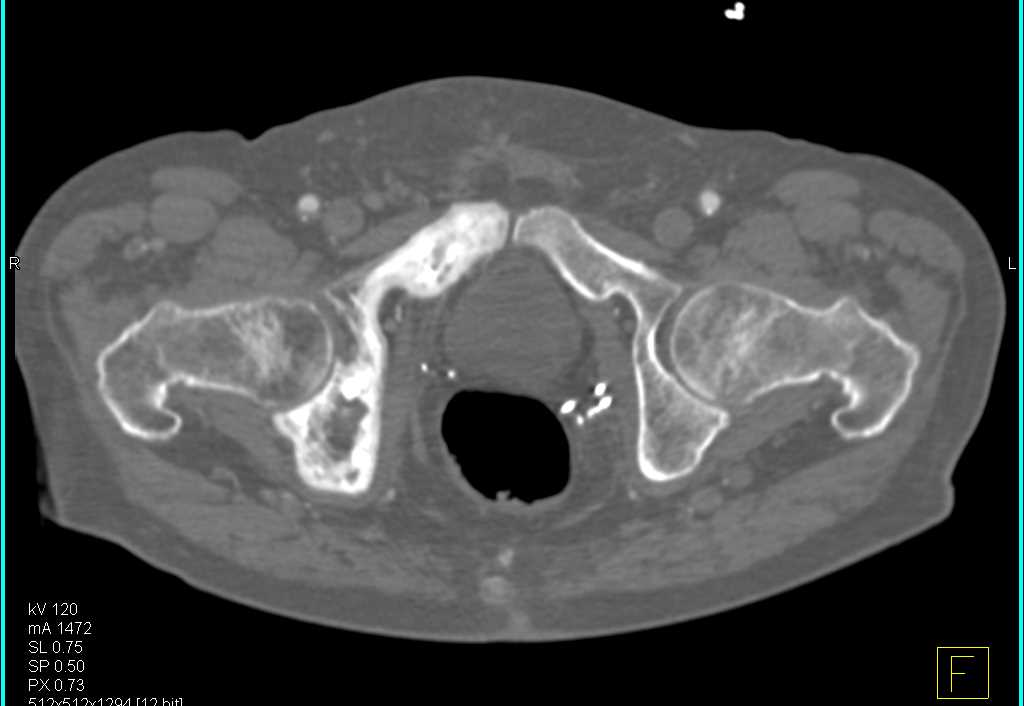 ctisus's tweet photo. Paget's Disease: https://t.co/ZlQsIRyyo9 https://t.co/SlEQLqxtnM