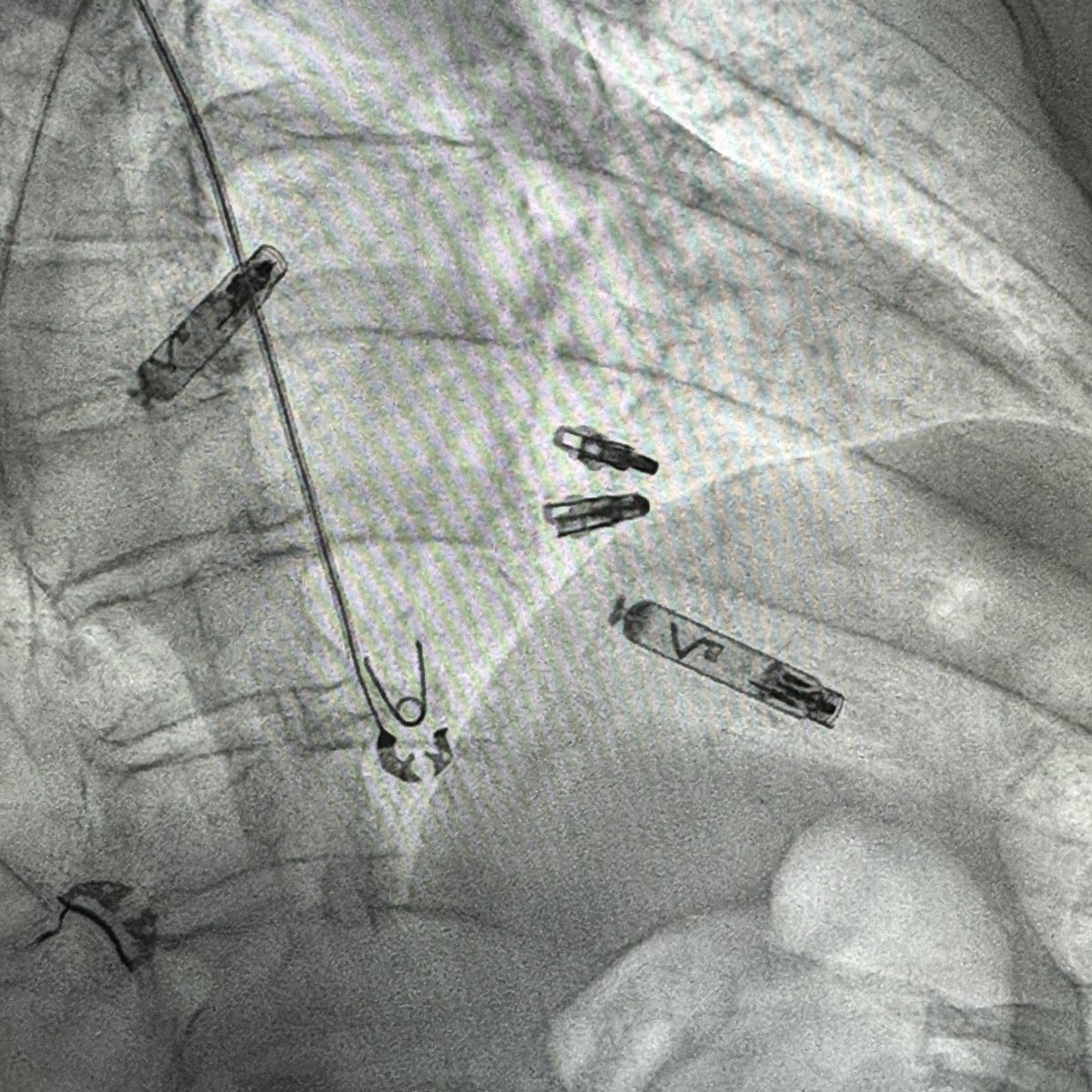Grateful to be training at <a href="/immc_imresident/">Illinois Masonic IMRes</a> <a href="/AdvocateAurora/">Advocate Aurora Health</a> One of the first medical centers to use the world’s first dual chamber leadless pacemaker system by <a href="/AbbottCardio/">Abbott Cardiovascular</a> 🫀⚡️ #CardioTwitter