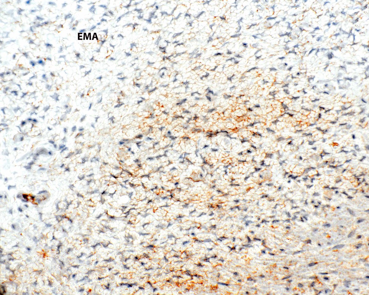 This lamina propria proliferation shows perineurial differentiation (perineurioma).  These are incidental and benign.  Usually the EMA is weak (someone made it more prominent using Photoshop). #UMiamiPath