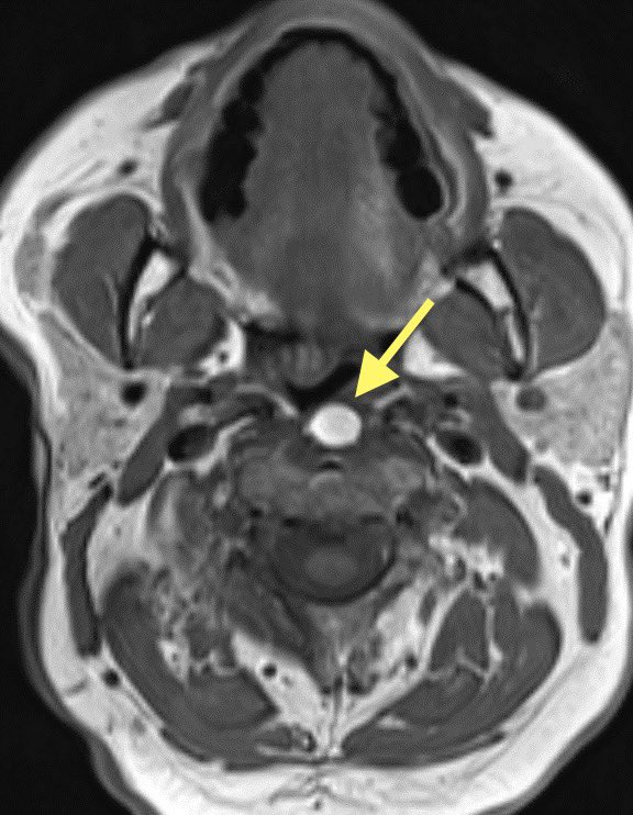 Can you guess the primary malignancy of this nodal metastasis? 🤔 Patient is a 50 y/o M 🧠 #ENT #Neurology @ASHNRSociety #radres #futureradres #MedEd #medicine