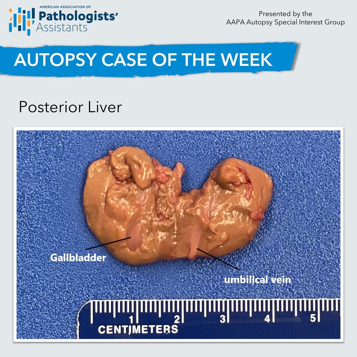 PathAssist's tweet photo. Welcome to the next Autopsy Case of the Week! This one is a test of your knowledge of congenital abnormalities – do you know the answer? 🤔
Comment with your guess below - we'll post the correct answer in a few days.
#autopsypathology #pathassist #pathologistsassistant #pathology https://t.co/1JuomyqBJ3