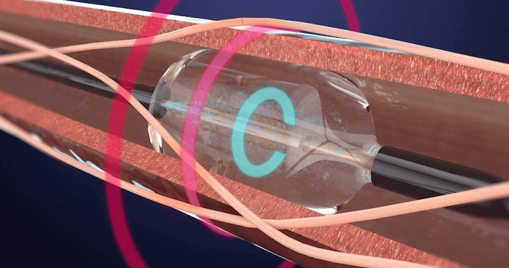 Carlos G Santos-Gallego, MD (@santosgallegomd) on Twitter photo And just like that…renal denervation (ultrasound, Paradise/Recor) is FDA-approved
A therapy in search of the adequate patients 
recormedical.com/recor-medical-…
<a href="/AnastasiaSMihai/">Dr Anastasia Mihailidou FAHA FCSANZ FESC</a>  <a href="/mvaduganathan/">Muthu Vaduganathan</a> <a href="/SJGreene_md/">Steve Greene</a> <a href="/ChristosArgyrop/">Christos Argyropoulos MD PhD 0kale/acc 🇺🇸</a> <a href="/Nephro_Sparks/">Matthew Sparks, MD</a> <a href="/jbrianbyrd/">J. Brian Byrd</a> <a href="/brendonneuen/">Brendon Neuen</a> <a href="/kidney_boy/">Joel M. Topf, MD FACP</a> And just like that…renal denervation (ultrasound, Paradise/Recor) is FDA-approved
A therapy in search of the adequate patients 
recormedical.com/recor-medical-…
<a href="/AnastasiaSMihai/">Dr Anastasia Mihailidou FAHA FCSANZ FESC</a>  <a href="/mvaduganathan/">Muthu Vaduganathan</a> <a href="/SJGreene_md/">Steve Greene</a> <a href="/ChristosArgyrop/">Christos Argyropoulos MD PhD 0kale/acc 🇺🇸</a> <a href="/Nephro_Sparks/">Matthew Sparks, MD</a> <a href="/jbrianbyrd/">J. Brian Byrd</a> <a href="/brendonneuen/">Brendon Neuen</a> <a href="/kidney_boy/">Joel M. Topf, MD FACP</a>