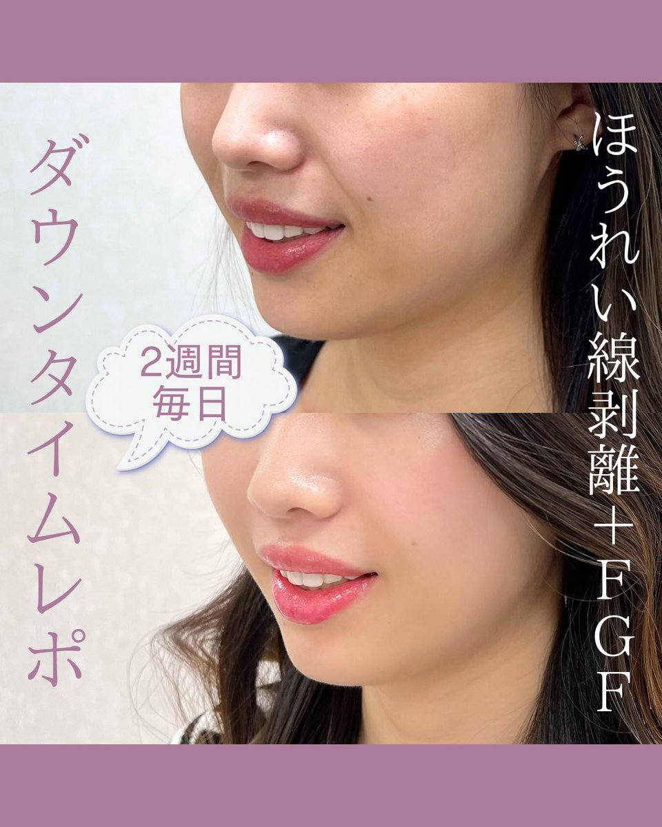 tokyobiyoiryo's tweet photo. 💎話題のほうれい線剥離💎
施術後0日〜13日、毎日のダウンタイムの経過を全見せします👏🏻✨✨ https://t.co/Ph1UKOjLng