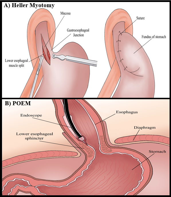 Danny Issa, MD (@dannyissamd) on Twitter photo "From Scalpel to Scope: How Surgical Techniques Made Way for Endoscopic Procedures"
Very excited to share our new publication at GastroHep Advances @ELSgastro reviewing state-of-the-art endoscopic techniques
Kudus to our team collaborators <a href="/UCLAHealth/">UCLA Health</a>
ghadvances.org/article/S2772-… "From Scalpel to Scope: How Surgical Techniques Made Way for Endoscopic Procedures"
Very excited to share our new publication at GastroHep Advances @ELSgastro reviewing state-of-the-art endoscopic techniques
Kudus to our team collaborators <a href="/UCLAHealth/">UCLA Health</a>
ghadvances.org/article/S2772-…