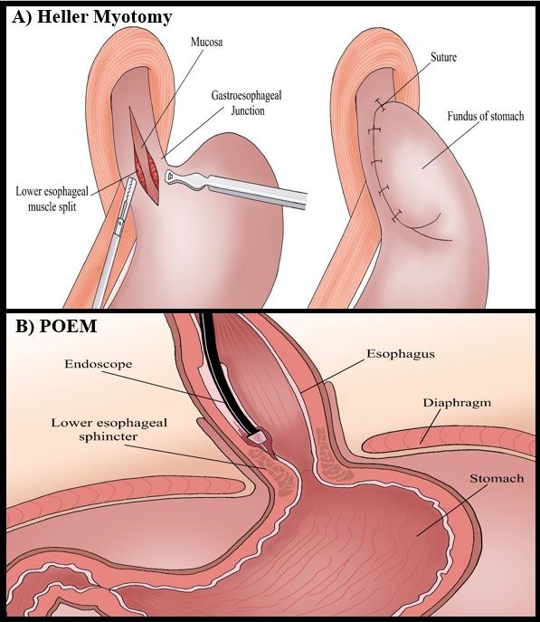 'From Scalpel to Scope: How Surgical Techniques Made Way for Endoscopic Procedures' Very excited to share our new publication at GastroHep Advances @ELSgastro reviewing state-of-the-art endoscopic techniques Kudus to our team collaborators @UCLAHealth ghadvances.org/article/S2772-…