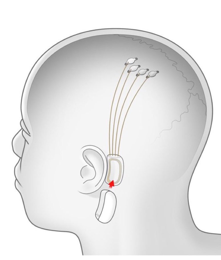 PopCrave's tweet image. Elon Musk’s chip implant company Neuralink is looking for its first volunteer.

They are looking for someone willing to have a piece of their skull removed so that a robotic surgeon can insert thin wires and electrodes into their brain.