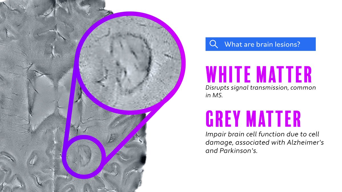braincastai's tweet photo. Happy #RadiologyDay! 🧠 MRI signal suppression reveals brain lesions, key in spotting trauma or disease. A huge thanks to the team at Capital Radiology for their expertise in high-quality scans! 🙌https://t.co/LI8y977I6I 
#BrainHealth https://t.co/5UAP9aMQCk