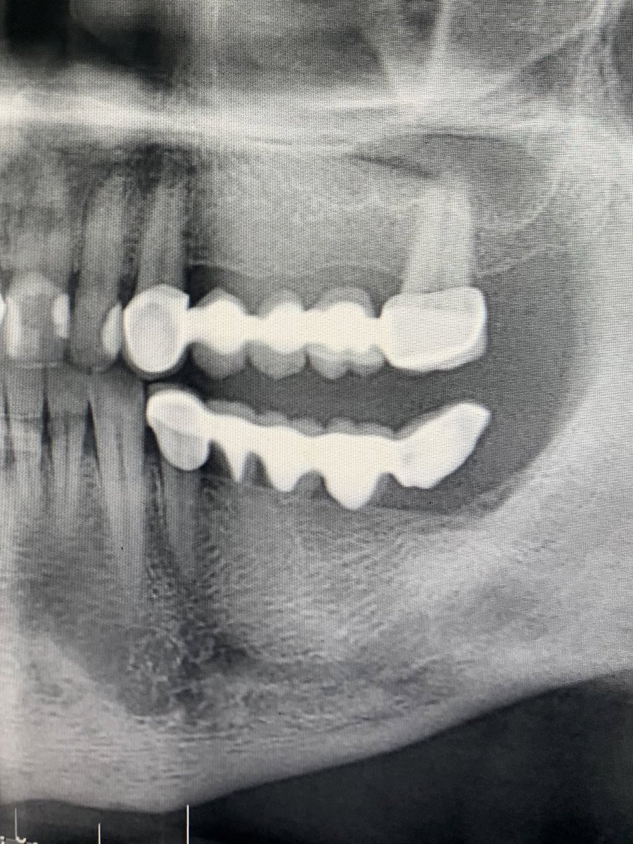 hareketli ve implant istemeyen hastaya yaptığım kantilever