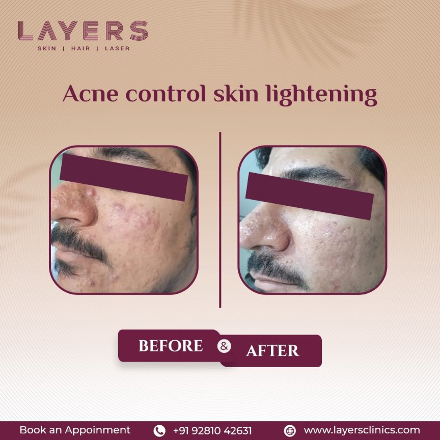 layersclinic's tweet image. Experience the remarkable journey of acne control and skin lightening through our before-and-after transformations. Say hello to clearer, brighter skin that radiates confidence.
Book your appointment today: 9281042631
#acnecontrol #layersclinics #layersskinand