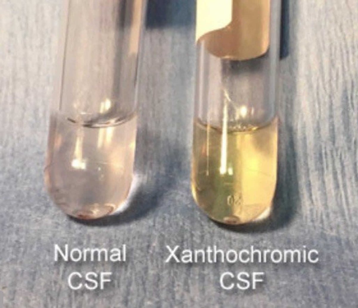 xanthochromic CSF in which type of intracranial hemorrhage we find it ?