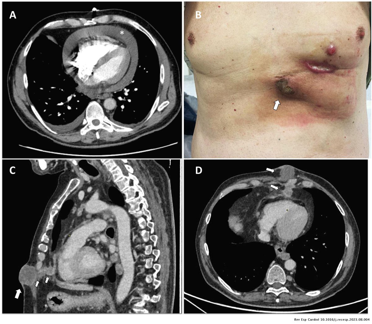 Metástasis subcutánea iatrogénica de adenocarcinoma pulmonar tras pericardiocentesis #REC #AheadOfPrint @TreSeRu revespcardiol.org//es-metastasis…