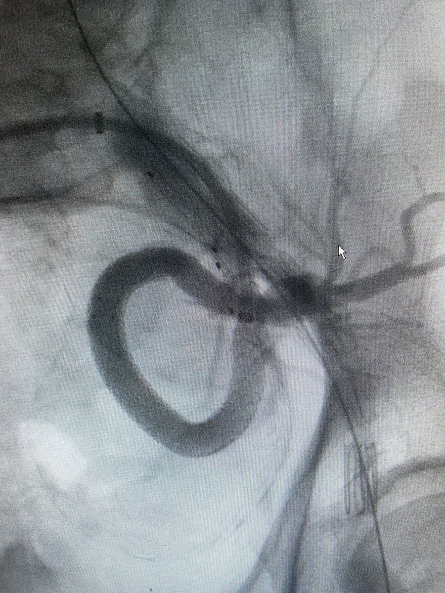T-Branch + left ZBIS branch. Large and long main hypogastric aneurysm. Just to show why I do like GORE material for severe angulated anatomy. #aortaEd