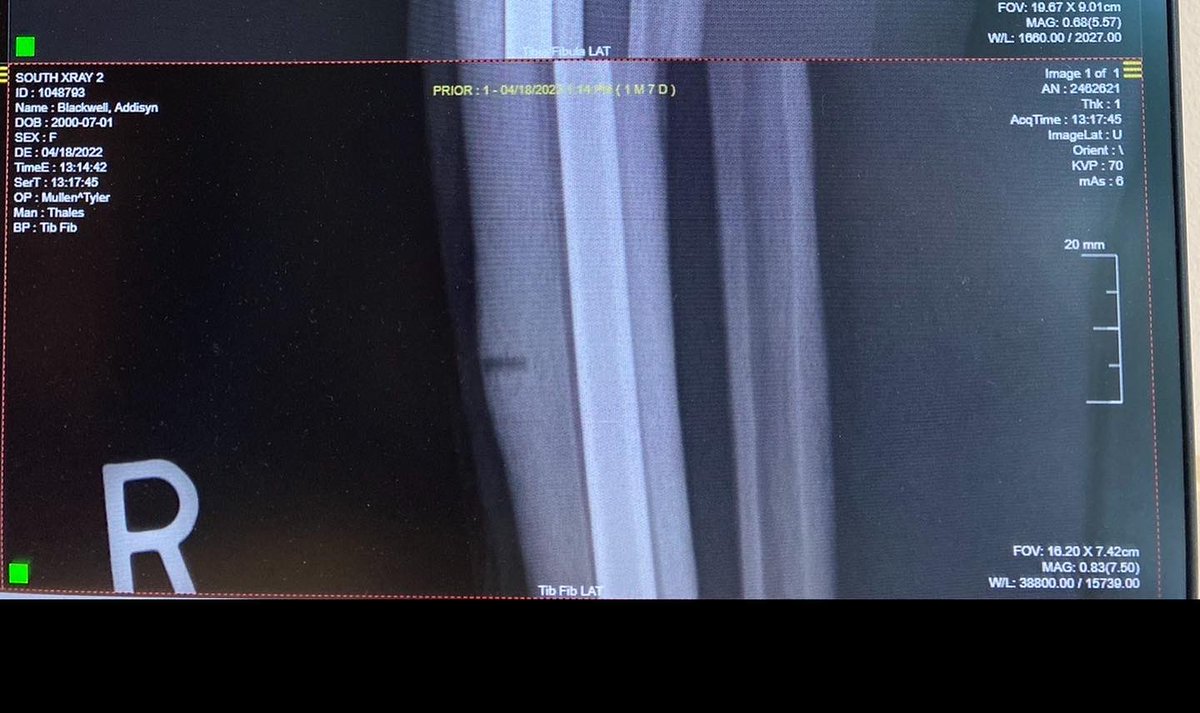 addyblackwell3's tweet photo. 600 days, 3 surgeries, 2 tibia fractures, compartment syndrome diagnosis, and a redshirt year later…I’m grateful to be back on the court!
Thankful for the friends, family, teammates, coaches, USI athletic training staff, and physical therapists who made this comeback possible!❤️ https://t.co/85YXMQPyRw