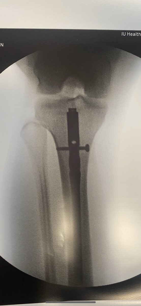 addyblackwell3's tweet photo. 600 days, 3 surgeries, 2 tibia fractures, compartment syndrome diagnosis, and a redshirt year later…I’m grateful to be back on the court!
Thankful for the friends, family, teammates, coaches, USI athletic training staff, and physical therapists who made this comeback possible!❤️ https://t.co/85YXMQPyRw