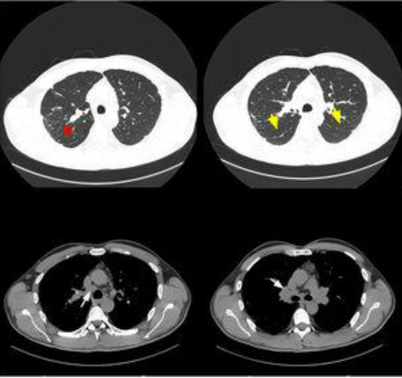 OpenRespiratory's tweet photo. 🩺​✉️​No te pierdas la última carta científica sobre la conexión entre la silicosis y la esclerodermia en el "Síndrome de Erasmus".

🔗 Enlace al estudio: https://t.co/ZpbvMfESDm 
#OpenRespiratory #SEPAR #Silicosis https://t.co/oxRT58KikX