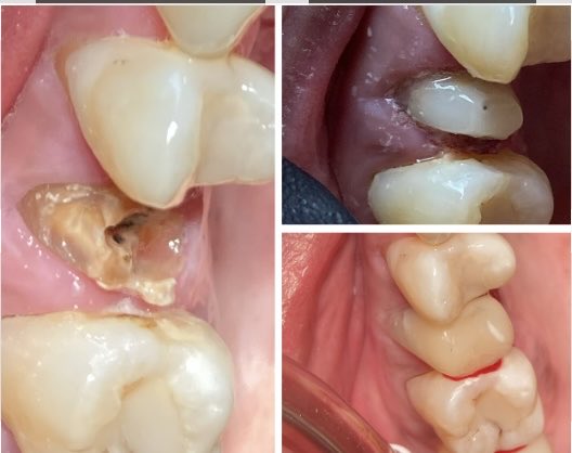 PratoHector's tweet photo. Reconstrucción con Zirconia nano ( forma ) en una sola sesión. https://t.co/UjPb1cviKU