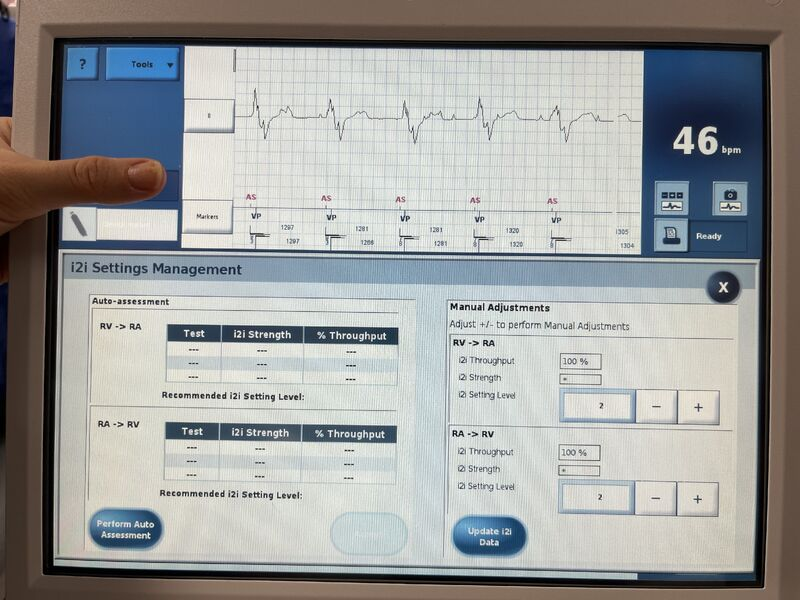 CyrusHadadiMD's tweet photo. @MedStarWHC implanted the 1st #Aveir DR dual chamber LP in an LVAD patient with CHB. @fsheikh22 and @MarkHofmeyer have a world class LVAD/transplant program and our @AbbottCardio #HeartMateII patient has AV synch with almost 0 infection risk! i2i communication is perfect! https://t.co/pfFfOcauwz