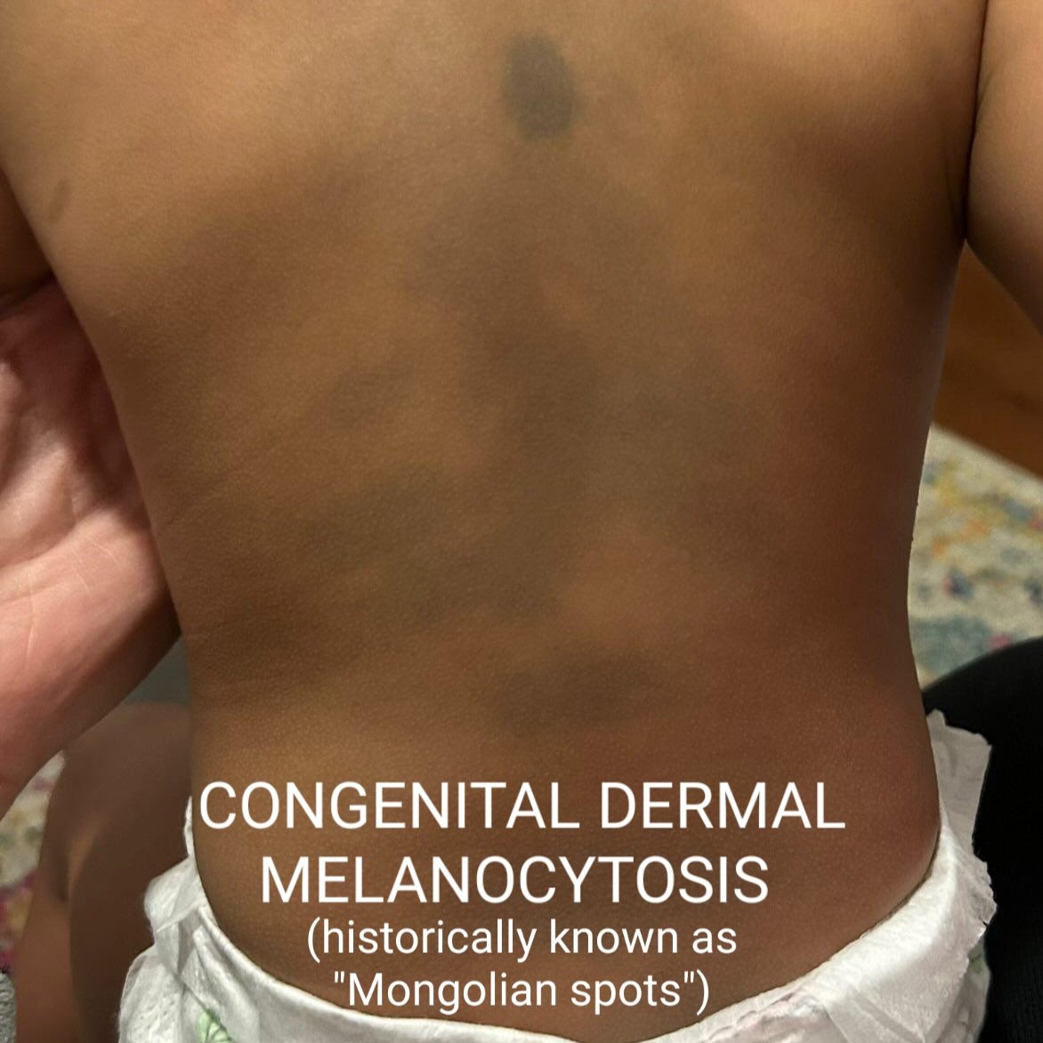 CDM (slate grey nevus, historically 'Mongolian spots') may look bruise-like and have been reported as abuse by child care workers. Pediatricians should be sure to document them. They are harmless and usually fade by puberty. #MedTwitter #childcare #teachersoftwitter #dermatology