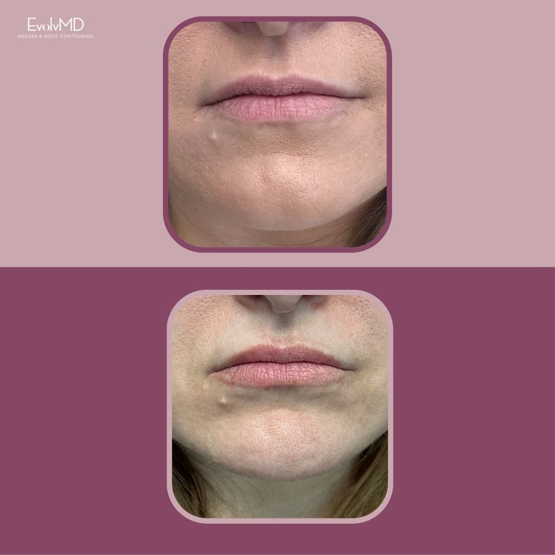 Before & After: Lip Fillers
We love a symmetrical natural plump lip 😘

Get some well-deserved rejuvenation & book your appointment today! Bring your best face home for the holidays. 

Call 414-479-0113
#injectables#dermalfillers#lipinjections#botox#lips#filler#lipfillers