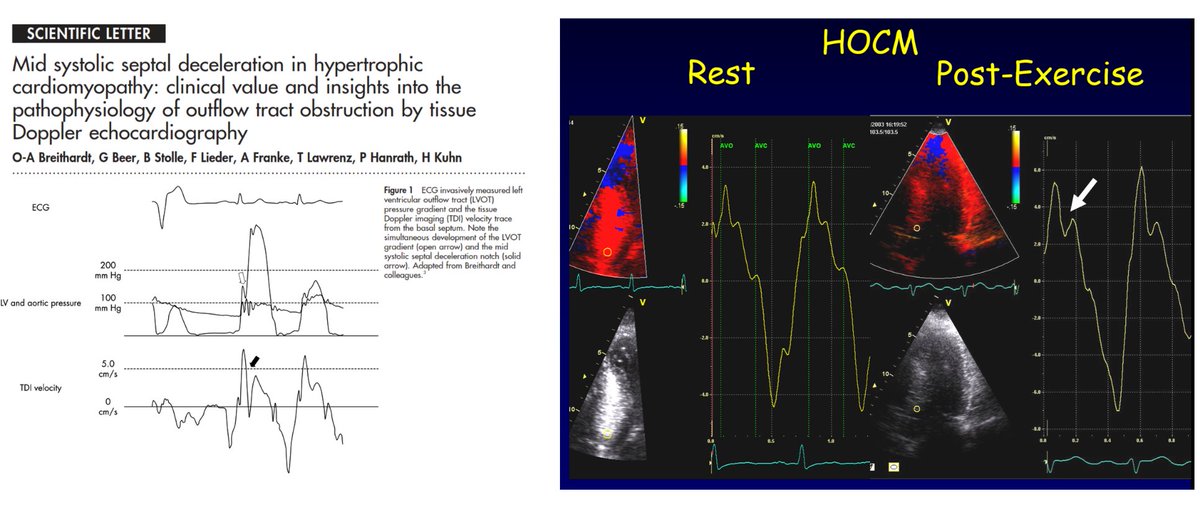 OAB1967's tweet photo. And do you know that the obstruction can also be seen in the basal septal wall by tissue Doppler? The MSSD sign...
#echofirst #CardioTwitter #hocm #tdi https://t.co/ypEUfYV7TG