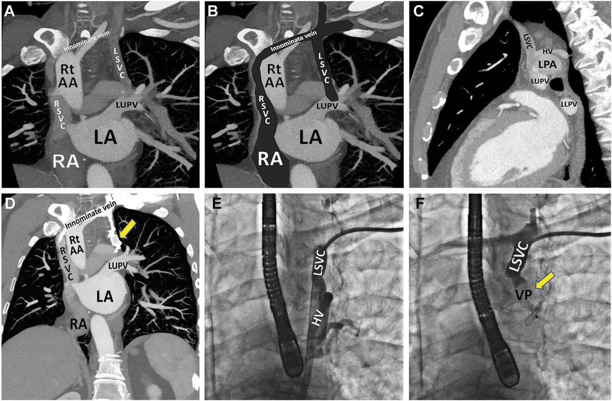 📚Imaging-guided percutaneous closure of persistent left-sided SVC draining into left upper PV &amp; causing right-to-left shunting leads to resolution of shunting &amp; symptom improvement.

➡️ doi.org/10.1016/j.jsca… 

<a href="/AJamilTajik/">Abdul Jamil Tajik</a> <a href="/HaroonZubairMD/">Haroon Zubair, MD</a> <a href="/renujain19/">Renu</a> <a href="/DanielJohnsrud/">Dan Johnsrud</a> <a href="/NMarzlin/">Nathan Marzlin</a>