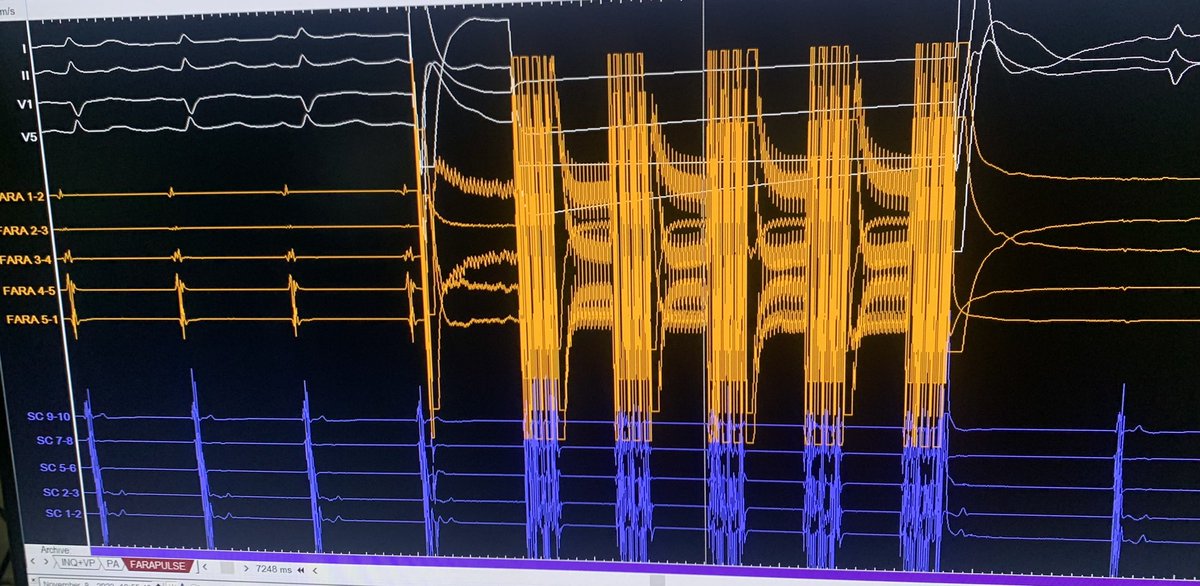 Santi (@santi_herher) on Twitter photo Primeros casos de ablación con Farapulse en <a href="/cardiosanjuan/">Cardiología San Juan</a> con <a href="/jmorarr/">Jose Moreno</a> <a href="/javiersamp/">javier</a> <a href="/carmenlucia/">Carmen Lúcia</a> Primeros casos de ablación con Farapulse en <a href="/cardiosanjuan/">Cardiología San Juan</a> con <a href="/jmorarr/">Jose Moreno</a> <a href="/javiersamp/">javier</a> <a href="/carmenlucia/">Carmen Lúcia</a>