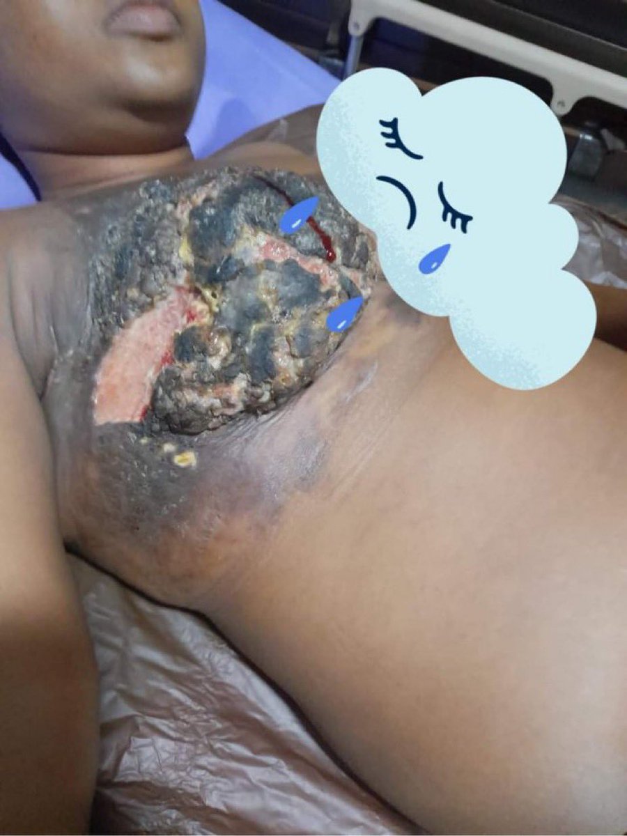 BishopPOEvang's tweet photo. This is the present condition of Chioma and how her Breàst looks like now, it has gotten to the size the Doc want before carrying out the surgery on her. Chioma still have additional 4 chemo injection to take, cuz of how bad the chest area is cuz of the inflammation those https://t.co/aCorXg0yA5