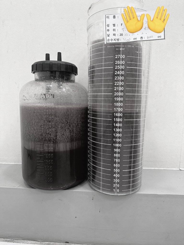 testuser_000's tweet image. 11/2 ニュースリム医院で上半身(二の腕、肩、前腕、ブラライン、お腹横・前)吸引してきました🐷🇰🇷

6000ccの内
純脂肪3200ccです( .ˬ. )

内出血、浮腫が酷いですが
めげずに昼職復帰してDT頑張てます🤗
経過が楽しみ🥰