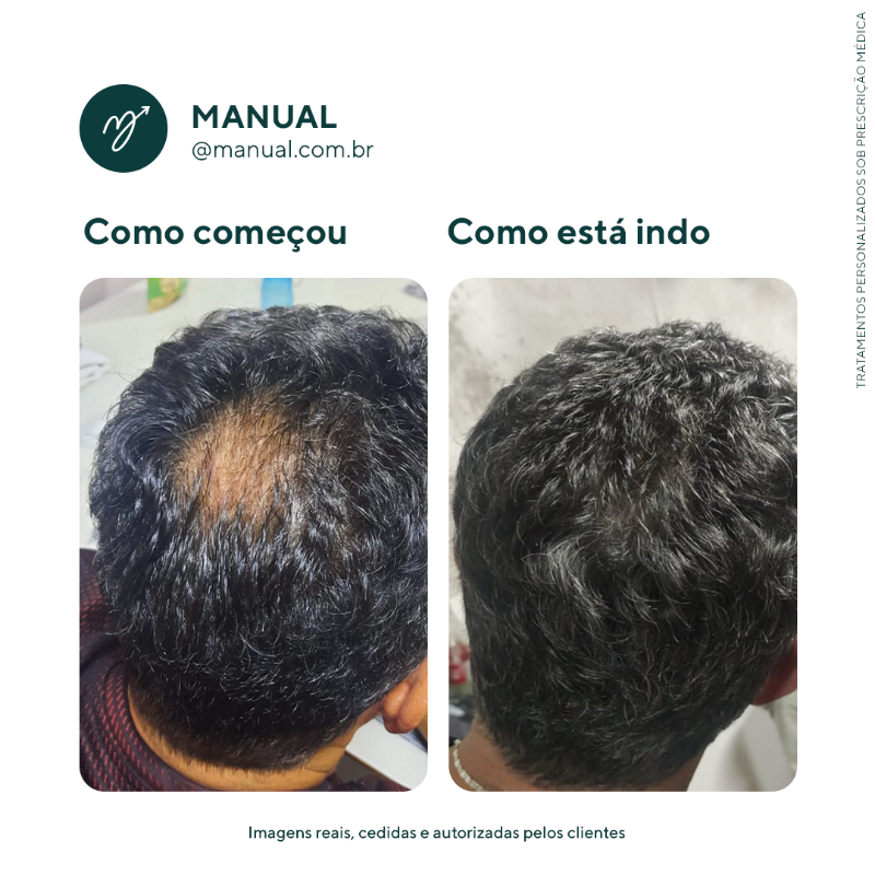 MANUAL_cabelo's tweet photo. Quer tratar a calvície? A MANUAL tem tudo o que você precisa para deixar o cabelo onde ele deve ficar!