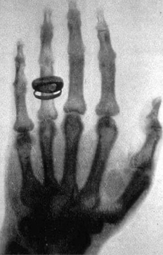 Alexny_85's tweet photo. ¡Y #TalDiaComoHoy de 1895, Wilhelm Conrad Roentgen descubre los rayos X, que revolucionarán disciplinas enteras, como la medicina o la cristalografía! Cuentan que cuando vió la fantasmal imagen de su mano, anillo incluido, a su mujer casi le da un infarto...
#DíaMundialRadiología https://t.co/1OfmcNlBG3
